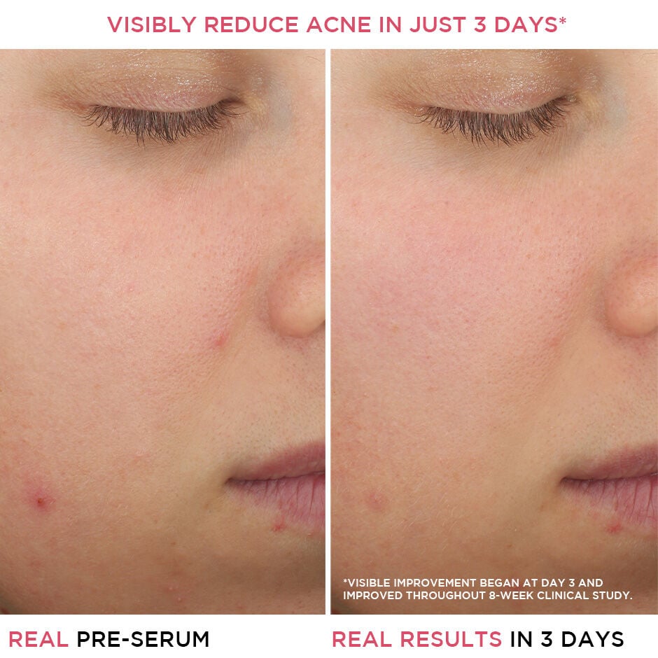 Salicylic acid outlet for acne