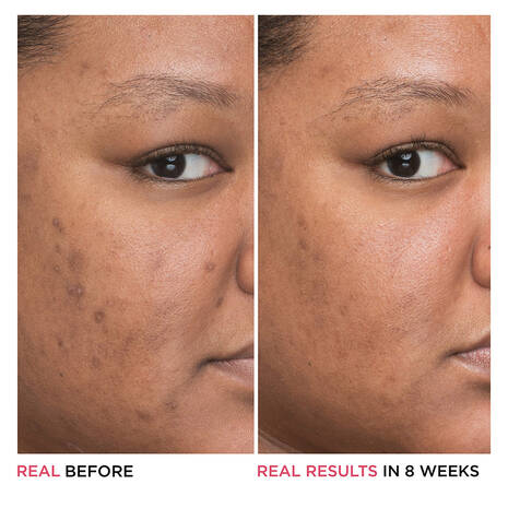 Bye Bye Dark Spots Niacinamide Serum It Cosmetics Bye Bye Dark Spots Niacinamide Serum It Cosmetics