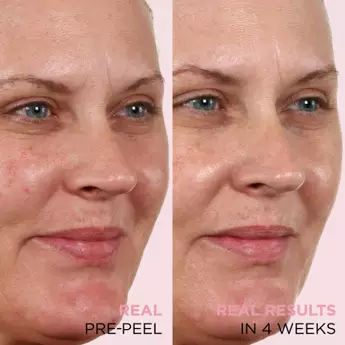 A before and after photo of the results of IT Cosmetics Hello Results Baby-Smooth Glycolic Acid Peel + Caring Oil. The before picture features text that reads "Real. Pre Peel," and the after picture features text that reads, "Real Results. In 4 weeks."