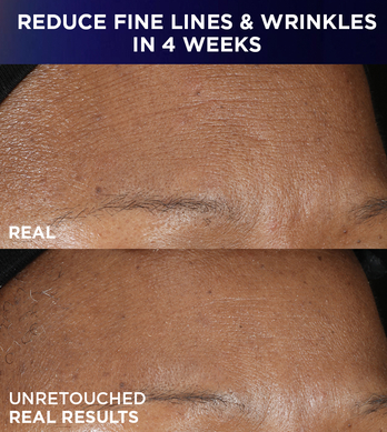 Before and after - reduce fine line and wrinkles in 4 weeks