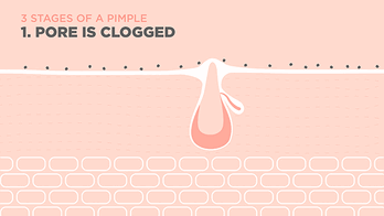 TARGETS ACNE AT EVERY STAGE