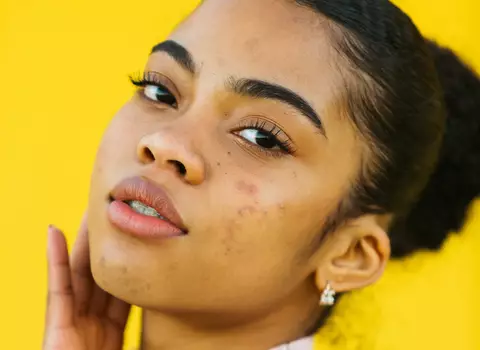 A photo of a woman with some acne scars
