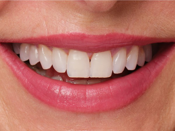 instantly reshapes your lips