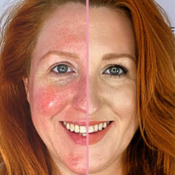Zoomed in before and after image showing a woman's skin with redness and without