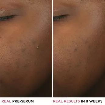 A side-by-side before and after photo shows a close-up of a woman's cheek with and without blemishes and text that reads, "Real Pre-Serum" and "Real Results In 8 Weeks."