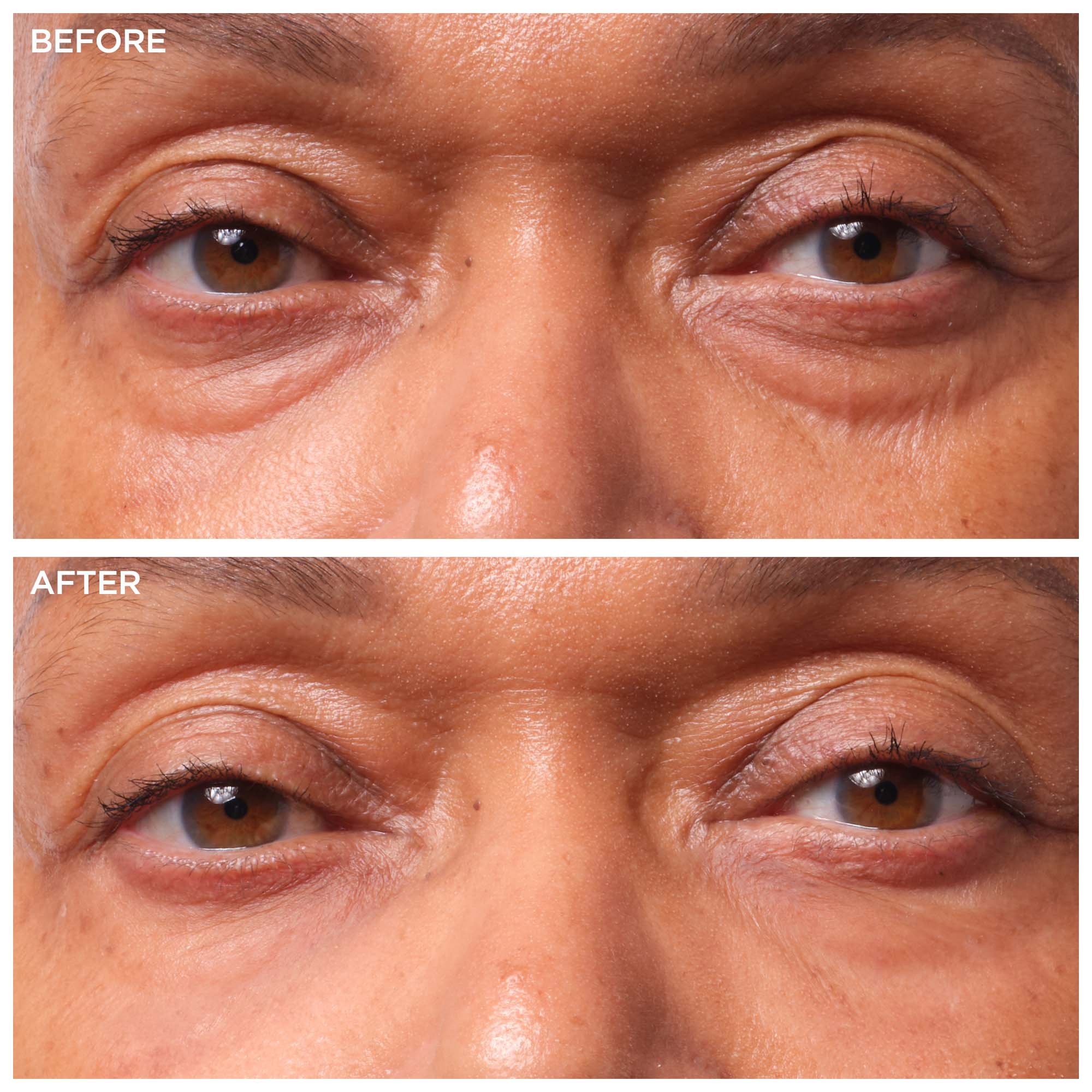 Under Eye Bag Laser Treatment  Oregon Derma Center