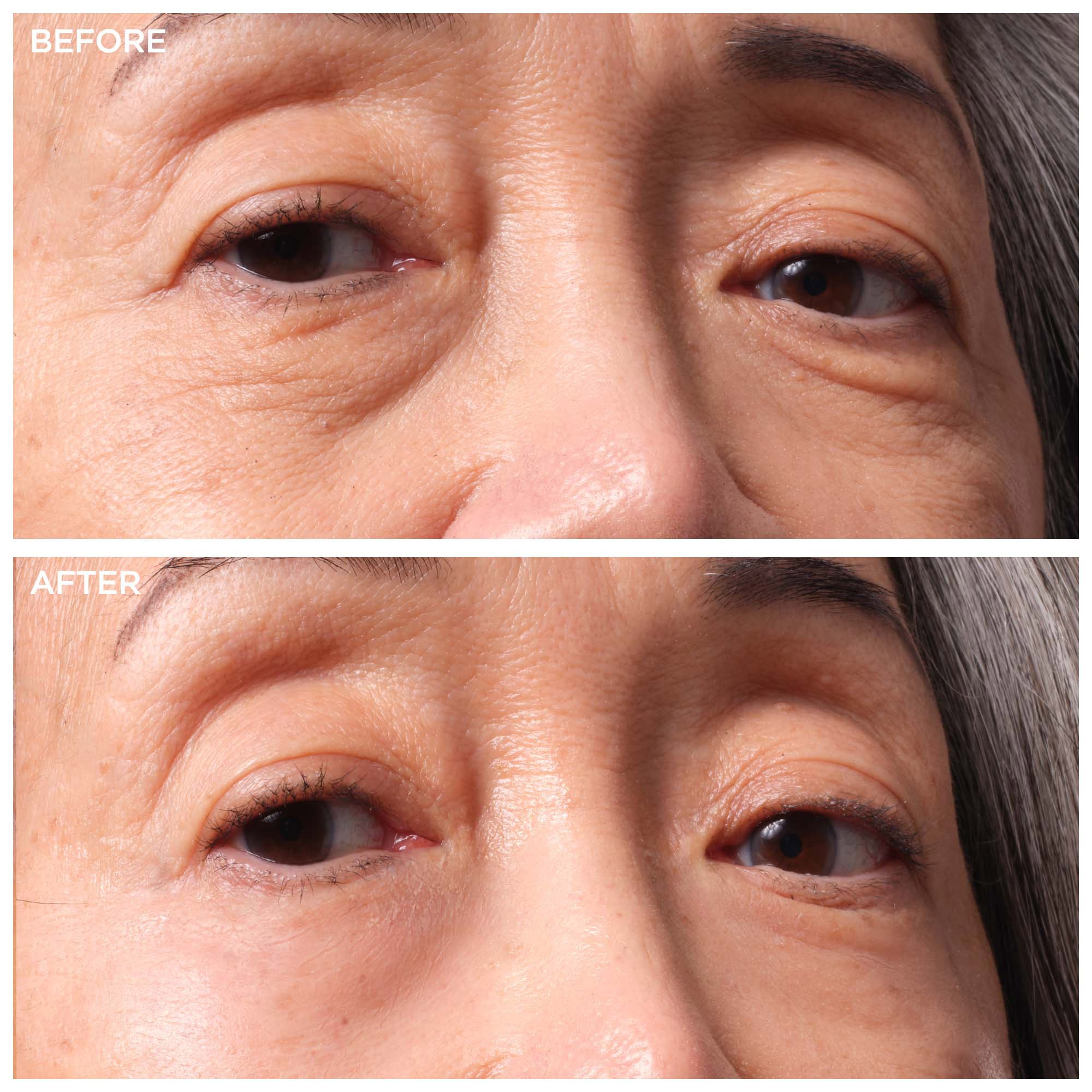 Bags Under Eyes Treatment Package