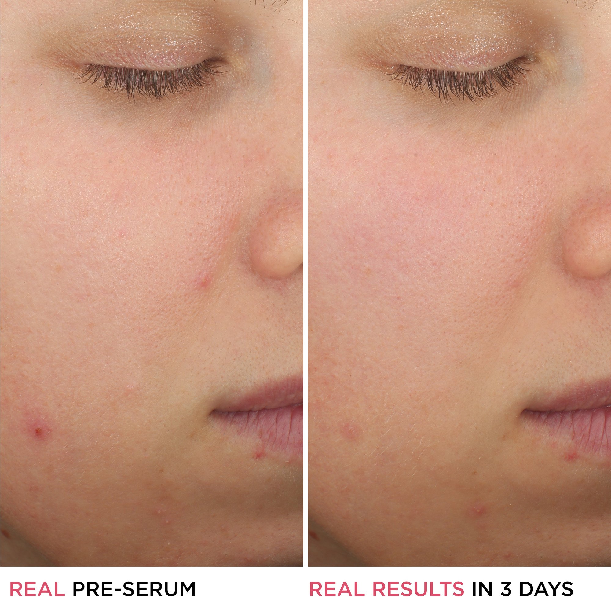 IT Cosmetics Bye Bye Breakout Serum
