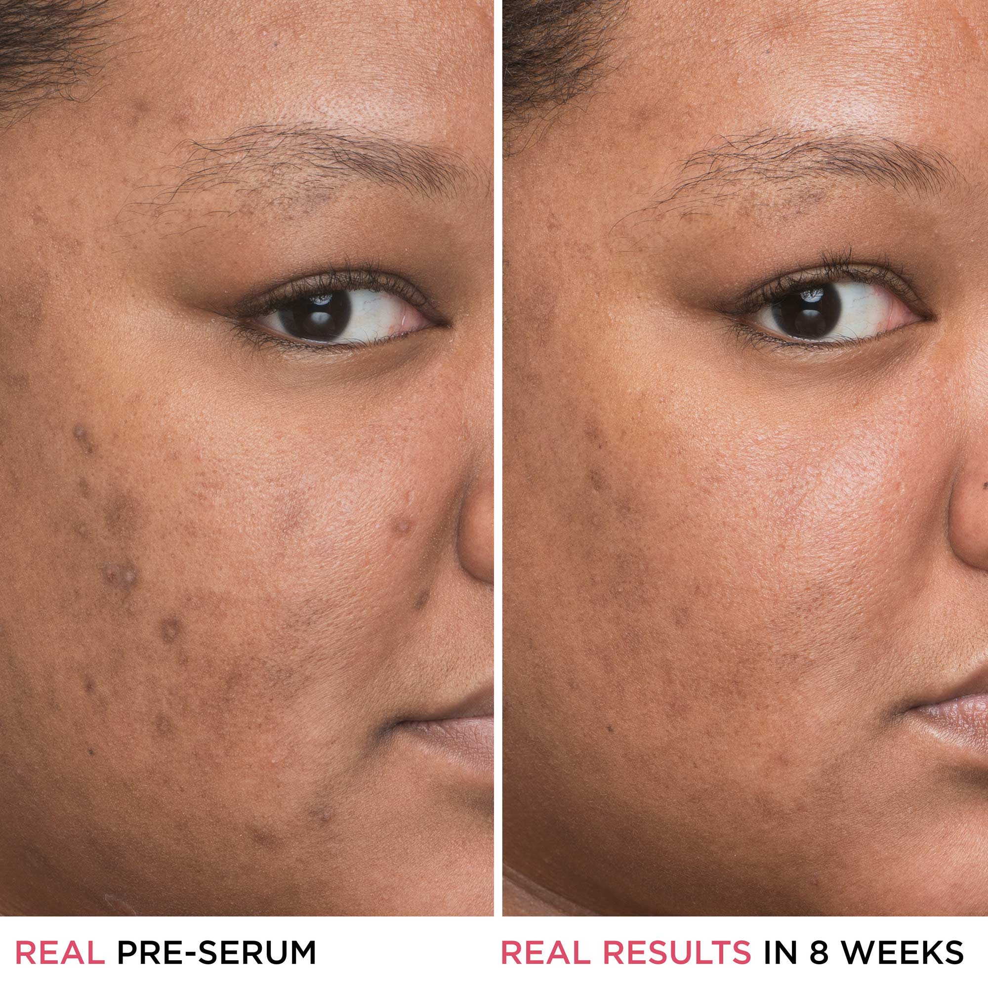 Niacinamide for on sale dry skin